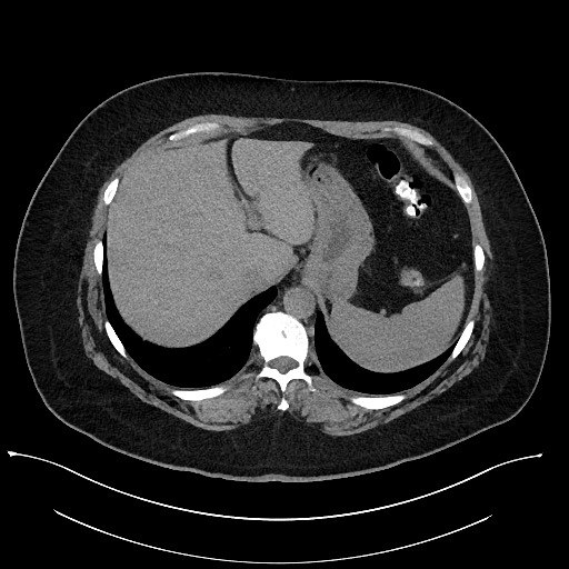 Carcinoid tumor - terminal ileum (Radiopaedia 60931-68740 Axial non-contrast 13).jpg