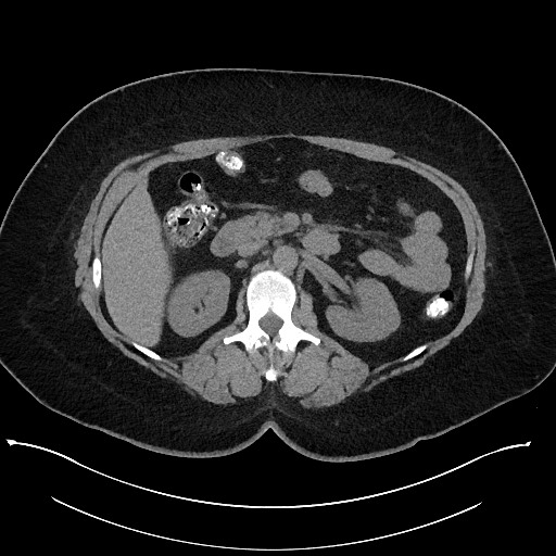 Carcinoid tumor - terminal ileum (Radiopaedia 60931-68740 Axial non-contrast 40).jpg