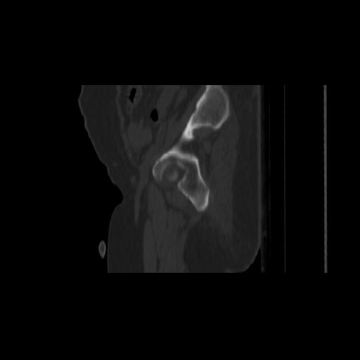 File:Carcinoma cervix- brachytherapy applicator (Radiopaedia 33135-34173 Sagittal bone window 24).jpg