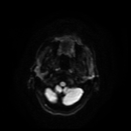 Carcinoma ex-pleomorphic adenoma of parotid (Radiopaedia 28383-28627 Ax DWI B-500 GE 57).jpg