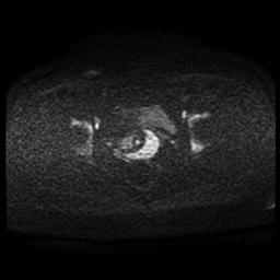 Carcinoma of the cervix (Radiopaedia 89018-105858 Axial DWI 73).jpg