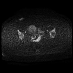 Carcinoma of the cervix (Radiopaedia 89018-105858 Axial DWI 74).jpg