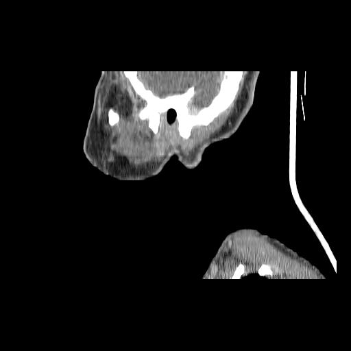 Carcinoma of the maxillary antrum (Radiopaedia 53805-59888 Sagittal C+ delayed 30).jpg