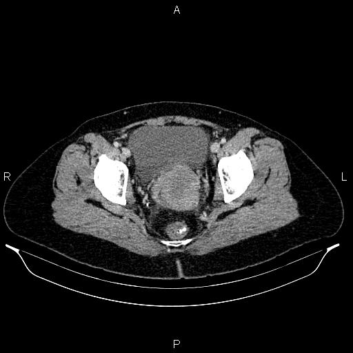Carcinoma of uterine cervix (Radiopaedia 85861-101700 A 71).jpg