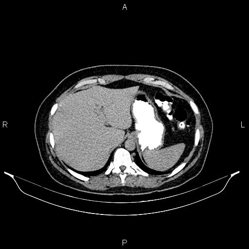 File:Carcinoma of uterine cervix (Radiopaedia 85861-101700 Axial C+ delayed 2).jpg