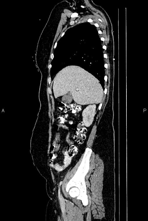 Carcinoma of uterine cervix (Radiopaedia 85861-101700 D 17).jpg