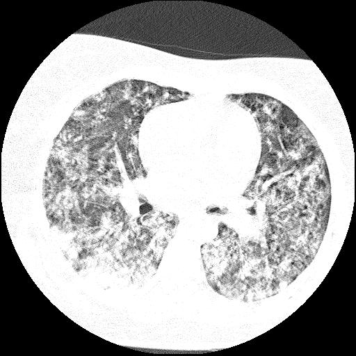 Cardiac angiosarcoma (Radiopaedia 66010-75181 Axial lung window 49).jpg