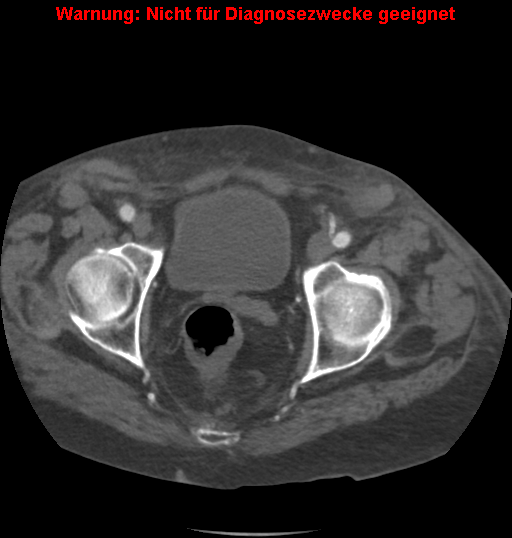 File:Cardiac perforation following transcatheter aortic valve implantation (Radiopaedia 23714-23863 B 5).png