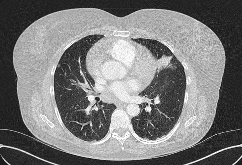 File:Cardiac sarcoidosis (Radiopaedia 74548-85534 Axial lung window 44).jpg