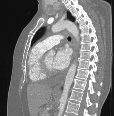 Cardiac sarcoidosis (Radiopaedia 74548-85534 Sagittal lung window 42).jpg