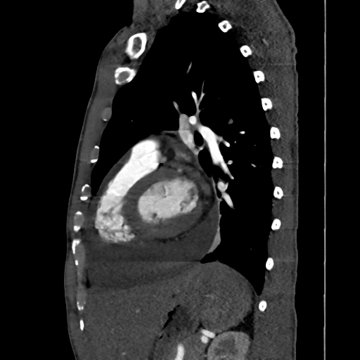 Cardiac tumor - undifferentiated pleomorphic sarcoma (Radiopaedia 45844-50134 B 25).png