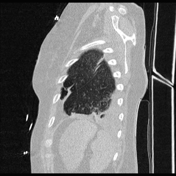 Cardiogenic pulmonary edema (Radiopaedia 29213-29609 Sagittal lung window 83).jpg