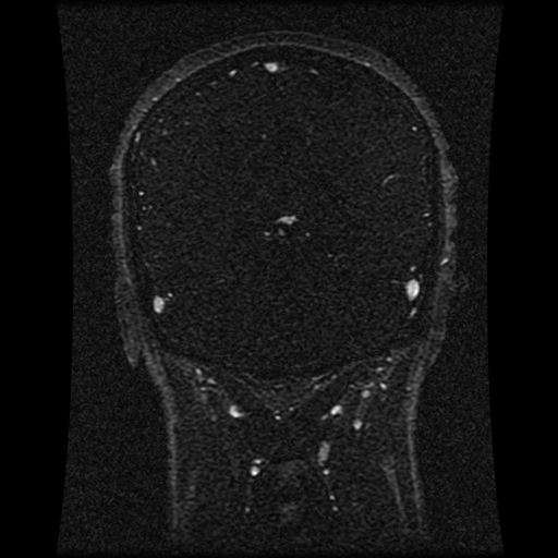File:Carotid arterial dissection with acute cerebral infarction (Radiopaedia 26636-26784 MRV 71).jpg