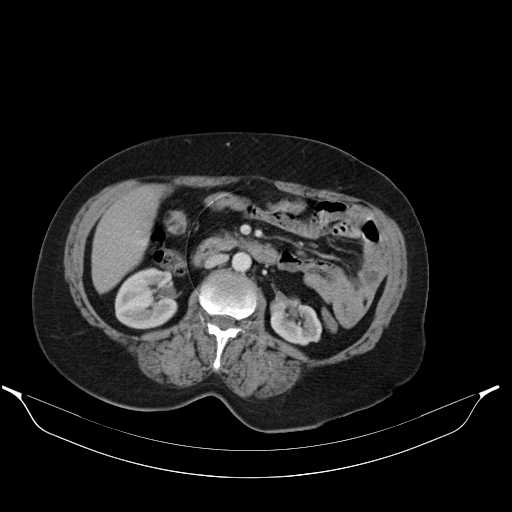File:Carotid body tumor (Radiopaedia 21021-20948 A 65).jpg