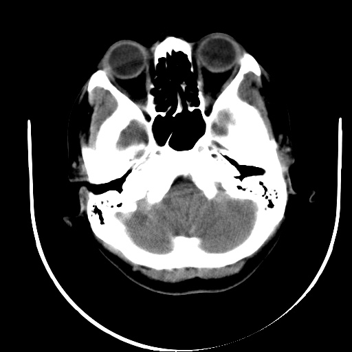 File:Carotid body tumor (Radiopaedia 27890-28124 A 1).jpg