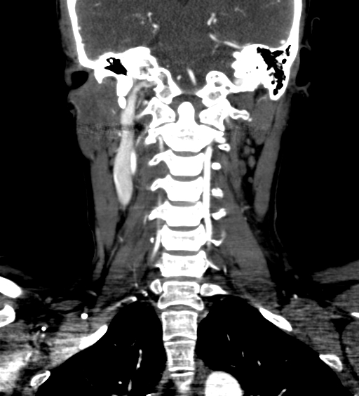 File:Carotid body tumor (Radiopaedia 39845-42300 C 65).jpg
