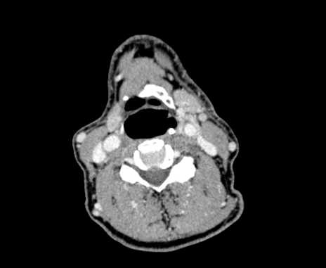 Carotid body tumor (Radiopaedia 61750-69757 Axial Post contrast 58).jpg