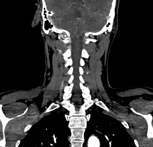 File:Carotid body tumor (Radiopaedia 83615-98727 B 96).jpg