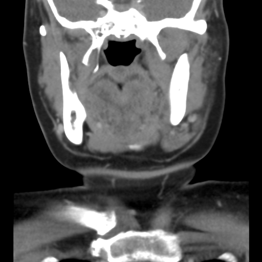 File:Carotid body tumor (paraganglioma) (Radiopaedia 38586-40729 B 16).jpg