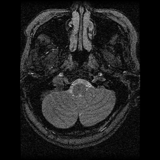 Cavernoma, DVA and right ICA aneurysm (Radiopaedia 33890-35072 E 102).png
