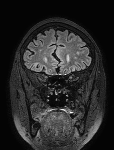 Cavernous hemangioma of the cerebellar falx (Radiopaedia 73025-83724 Coronal FLAIR 86).jpg