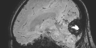 Cavernous hemangioma of the cerebellar falx (Radiopaedia 73025-83724 Sagittal BOLD 116).jpg