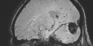 Cavernous hemangioma of the cerebellar falx (Radiopaedia 73025-83724 Sagittal BOLD 132).jpg