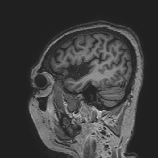 File:Cavernous hemangioma of the cerebellar falx (Radiopaedia 73025-83724 Sagittal T1 43).jpg