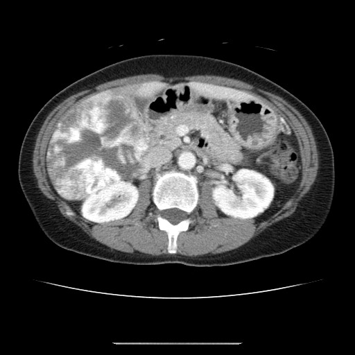 Cavernous hepatic hemangioma (Radiopaedia 75441-86667 B 46).jpg