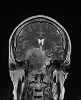 File:Cavernous sinus meningioma (Radiopaedia 63682-72367 Coronal T2 7).jpg