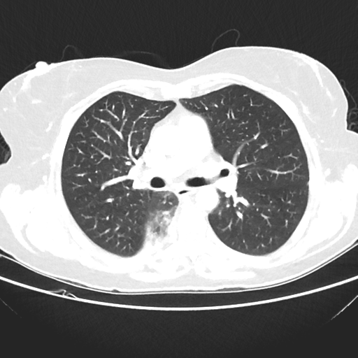 File:Cavitating lung mass - squamous cell carcinoma (Radiopaedia 48047-52854 Axial lung window 22).png
