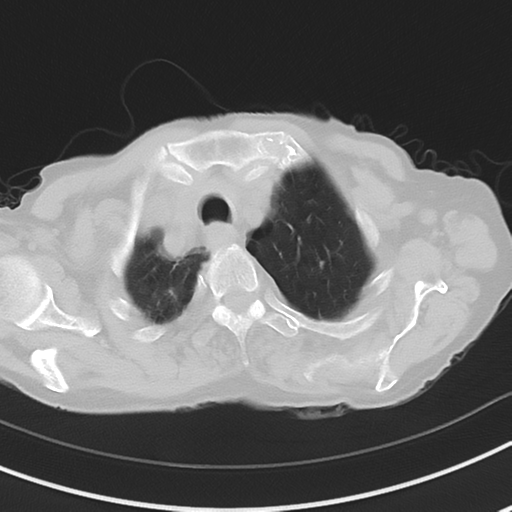 Cavitating pneumonia - lingular segments (Radiopaedia 34386-35678 Axial lung window 11).png