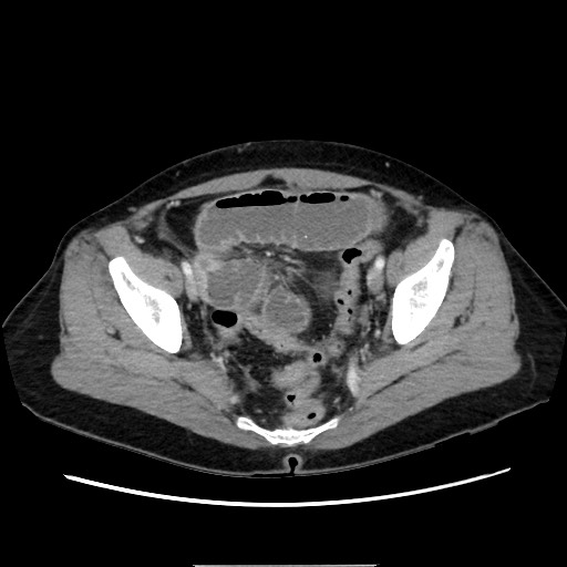 Cecal adenocarcinoma (Radiopaedia 75909-87331 A 75).jpg