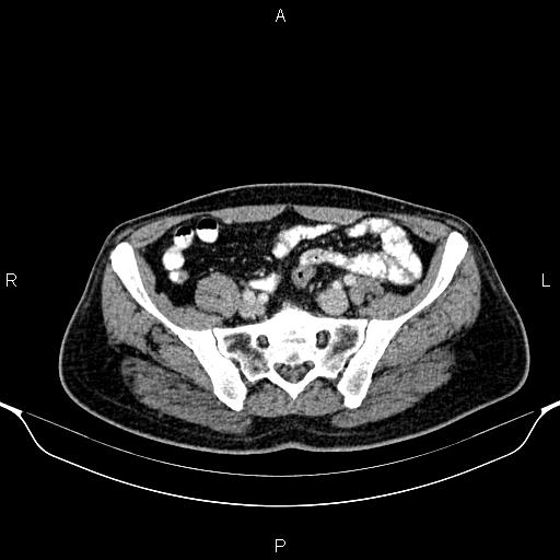Cecal adenocarcinoma (Radiopaedia 85324-100916 B 73).jpg