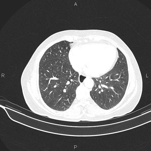 Cecal cancer (Radiopaedia 85610-101358 Axial lung window 45).jpg