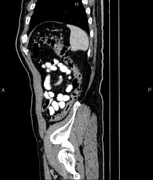 File:Cecal cancer with appendiceal mucocele (Radiopaedia 91080-108651 E 83).jpg