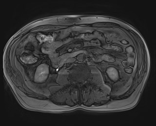 File:Cecal mass causing appendicitis (Radiopaedia 59207-66532 K 71).jpg