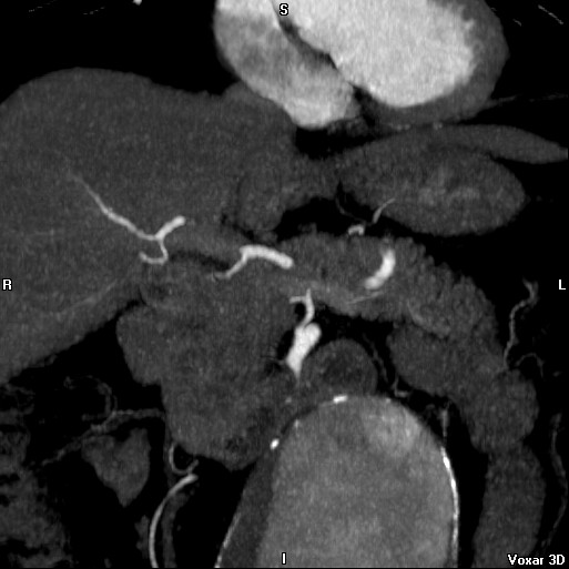 File:Celiac artery anatomy (Radiopaedia 16763-16476 A 6).jpg