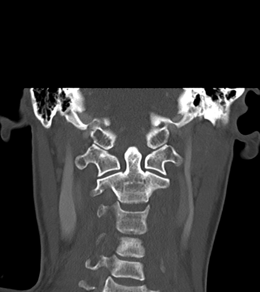 Cemento-ossifying fibroma (Radiopaedia 46243-50643 Coronal bone window 43).png