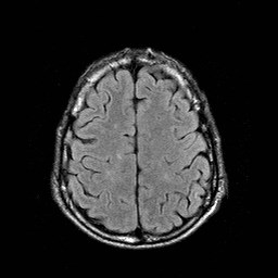 File:Central-variant posterior reversible encephalopathy syndrome (PRES) (Radiopaedia 43880-47358 Axial FLAIR 19).jpg