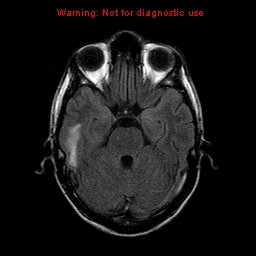 File:Central nervous system vasculitis (Radiopaedia 8410-9235 Axial FLAIR 8).jpg