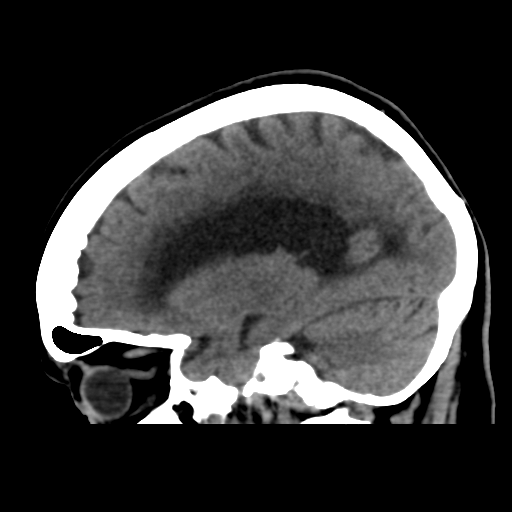 File:Central neurocytoma (Radiopaedia 65317-74346 C 20).png