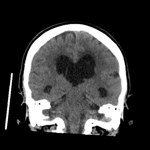 Central neurocytoma (Radiopaedia 65317-74346 Coronal non-contrast 36).png