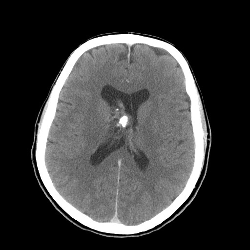 File:Central neurocytoma (Radiopaedia 68725-78432 Axial C+ 49).jpg