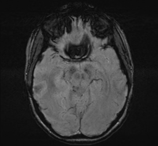 Central neurocytoma (Radiopaedia 70263-80336 Axial SWI 22).jpg