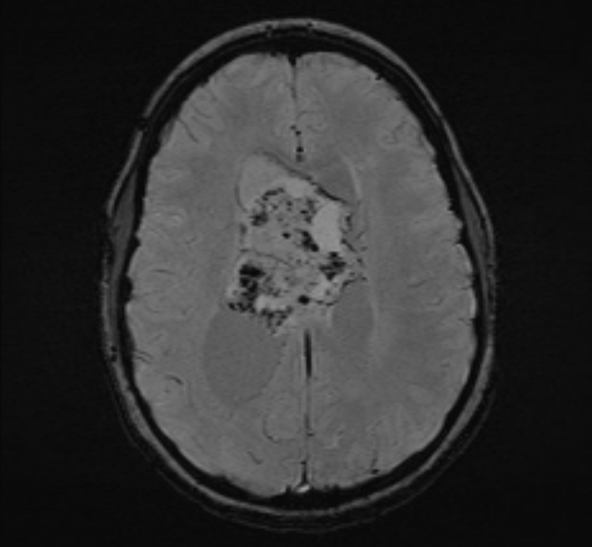 Central neurocytoma (Radiopaedia 70263-80336 Axial SWI 37).jpg