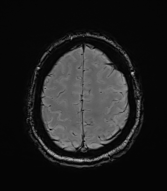 File:Central neurocytoma (Radiopaedia 71068-81303 Axial SWI 54).jpg