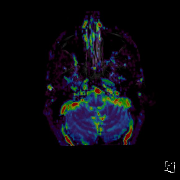 Central neurocytoma (Radiopaedia 84497-99872 Axial Perfusion 270).jpg