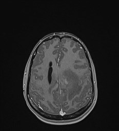 File:Central neurocytoma (Radiopaedia 84497-99872 Axial T1 C+ 112).jpg