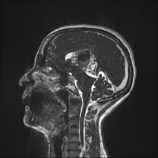 Central neurocytoma (Radiopaedia 84497-99872 Sagittal CISS 46).jpg